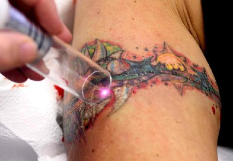 Tattoo entfernen Laser