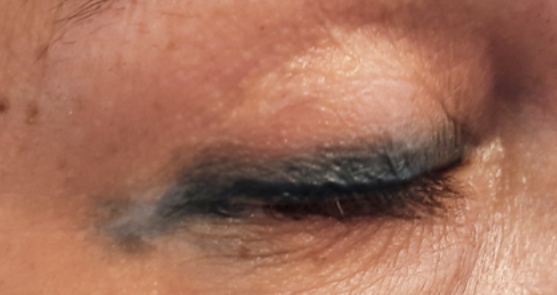 skin areas of the eyelid