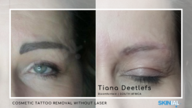 Eyebrows removed – one treatment