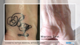 Wrist tattoos – 3 treatments