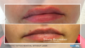 Lip correction – one treatment