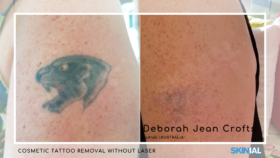 Full-surface tattoo – 4 treatments