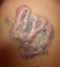 Classic keloid 