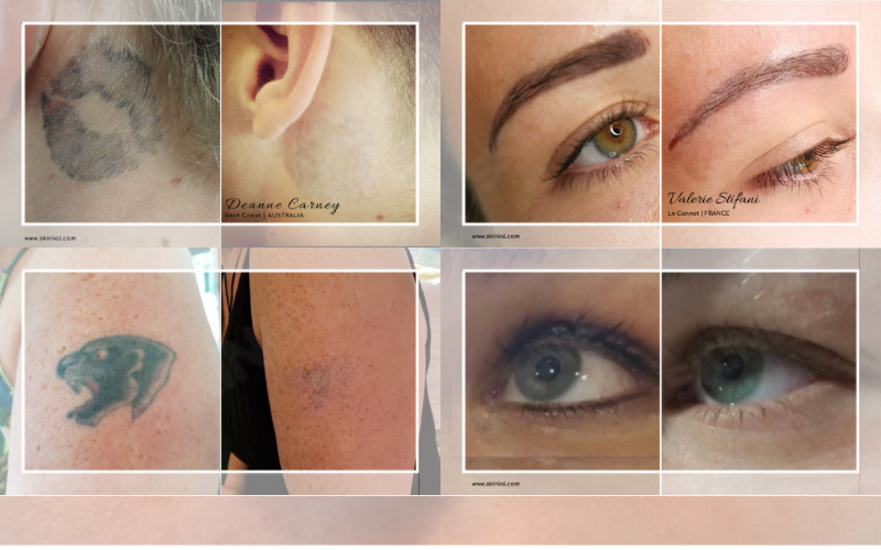 Tattoo Removal | Chasse Permanent Makeup